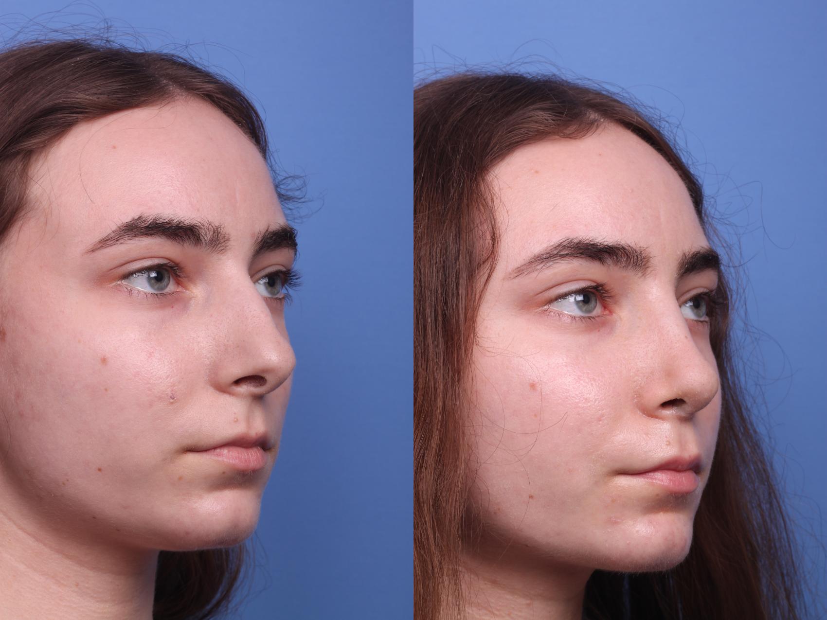 Before & After Rhinoplasty Case 135 View #3 View in Scottsdale, AZ