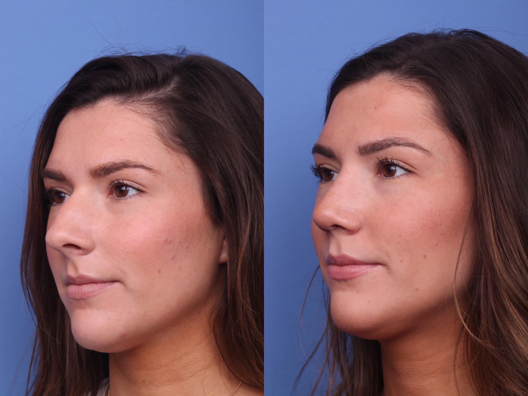 Before & After Rhinoplasty Case 136 View #2 View in Scottsdale, AZ