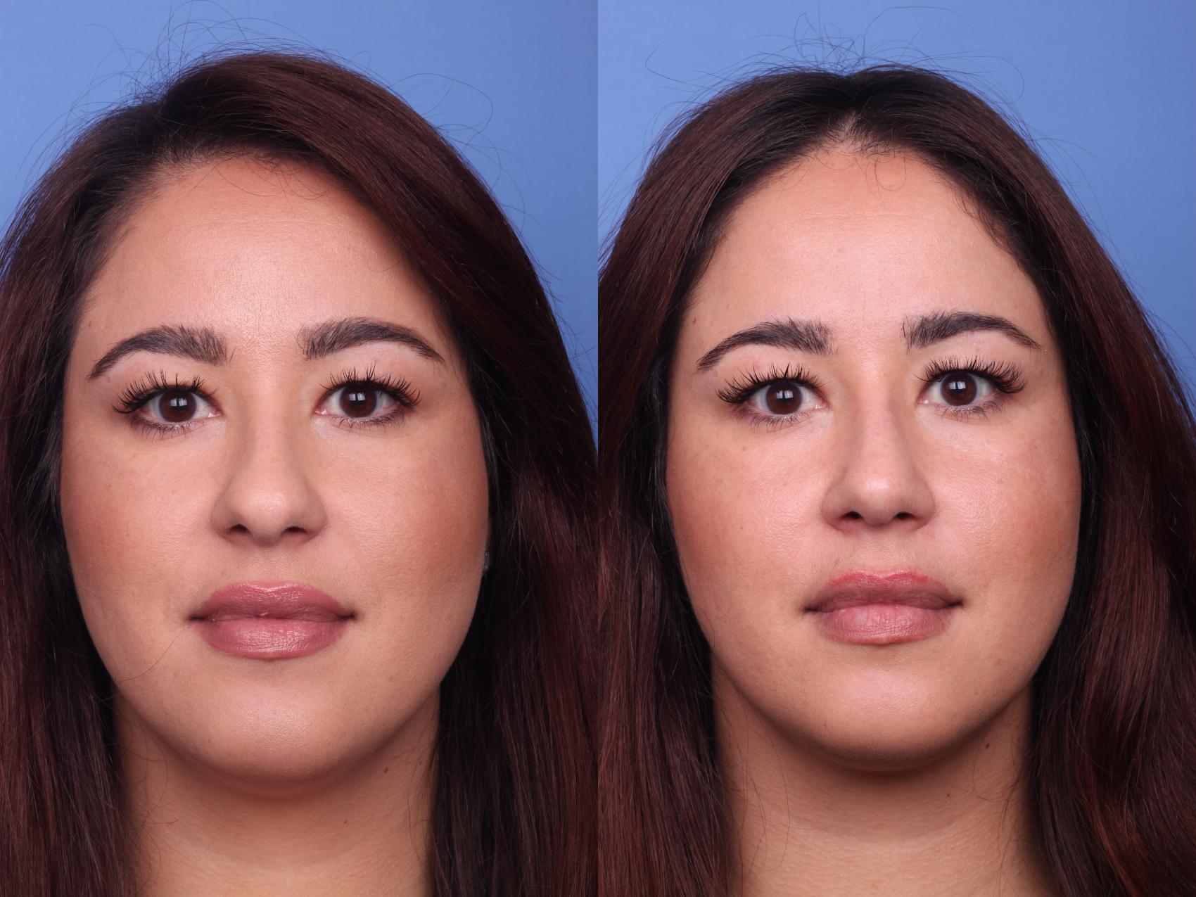 Before & After Rhinoplasty Case 138 View #2 View in Scottsdale, AZ