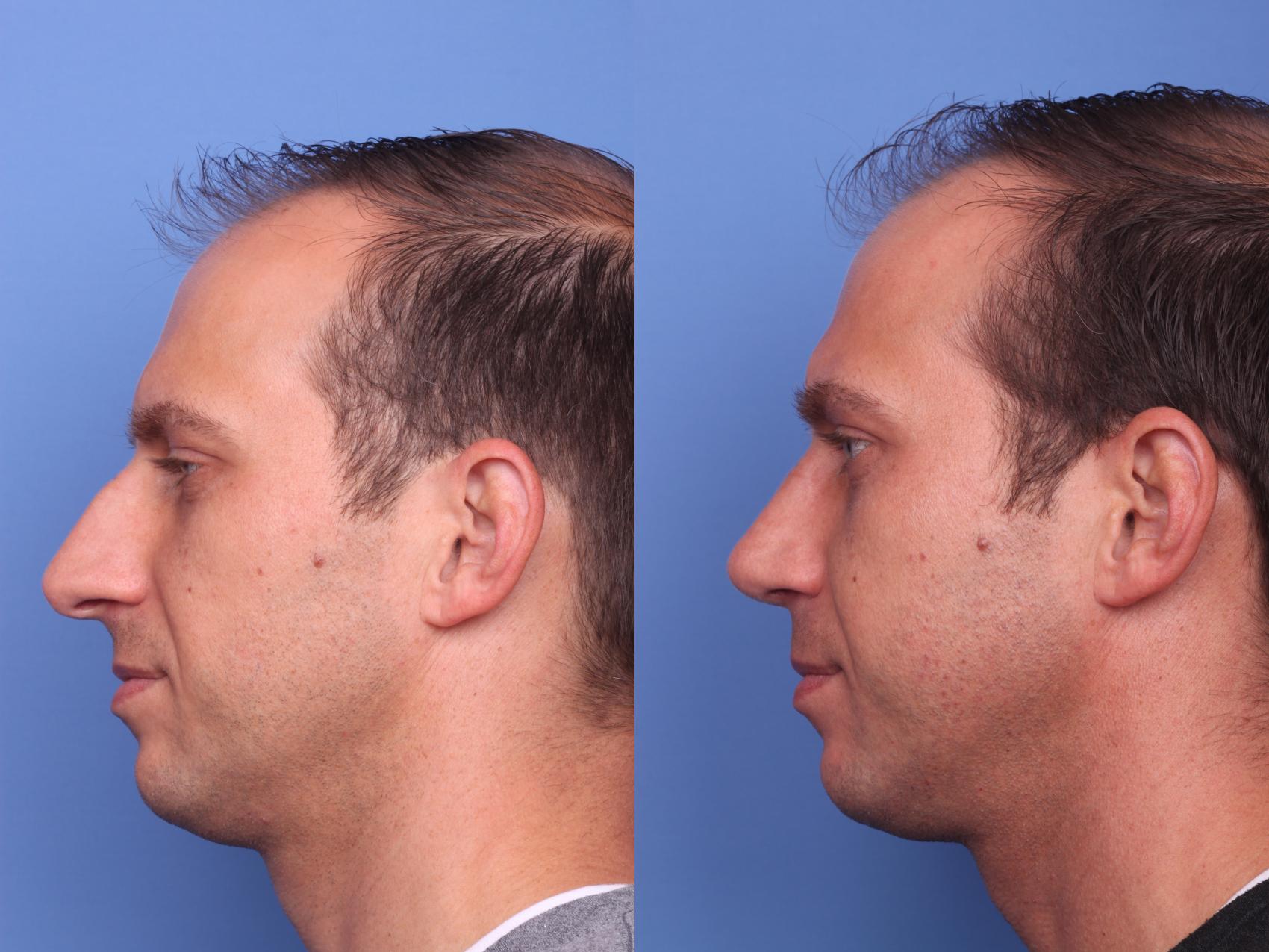 Before & After Rhinoplasty Case 139 View #2 View in Scottsdale, AZ