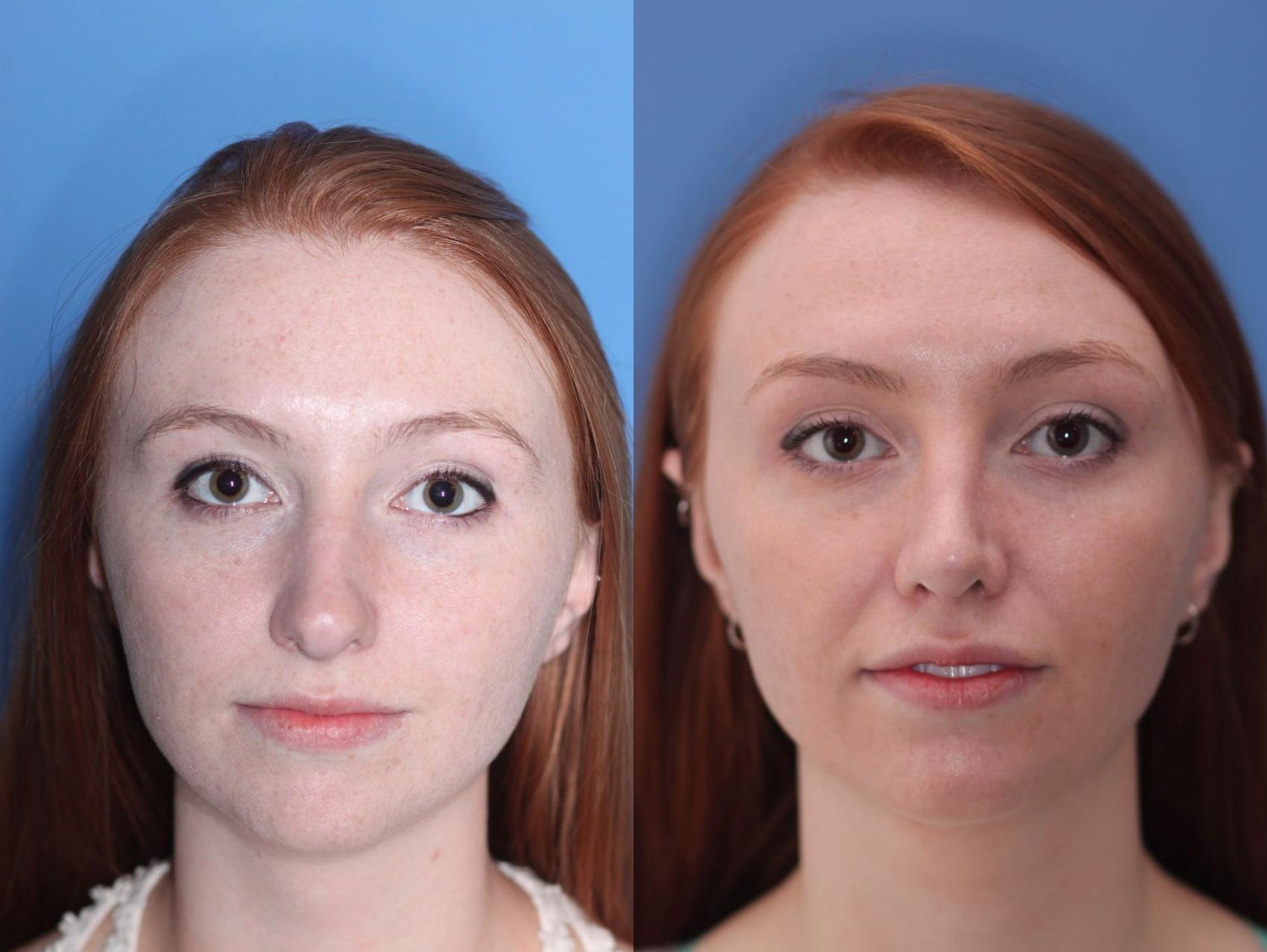 Before & After Rhinoplasty Case 14 View #2 View in Scottsdale, AZ