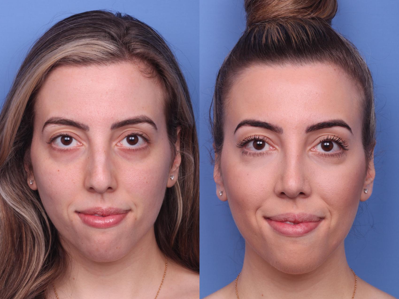 Before & After Rhinoplasty Case 140 View #2 View in Scottsdale, AZ