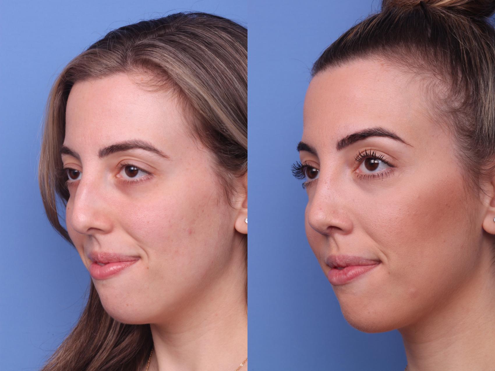 Before & After Rhinoplasty Case 140 View #3 View in Scottsdale, AZ