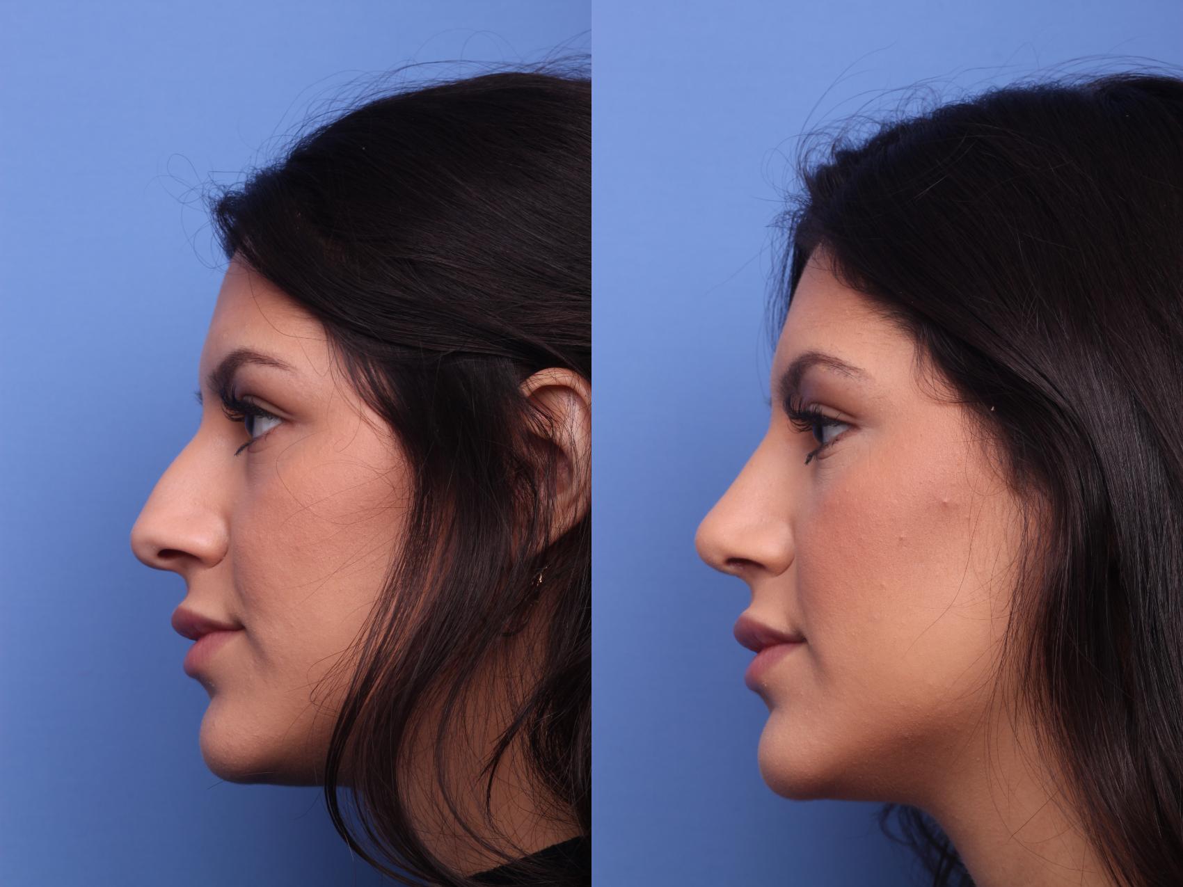 Before & After Rhinoplasty Case 143 View #2 View in Scottsdale, AZ