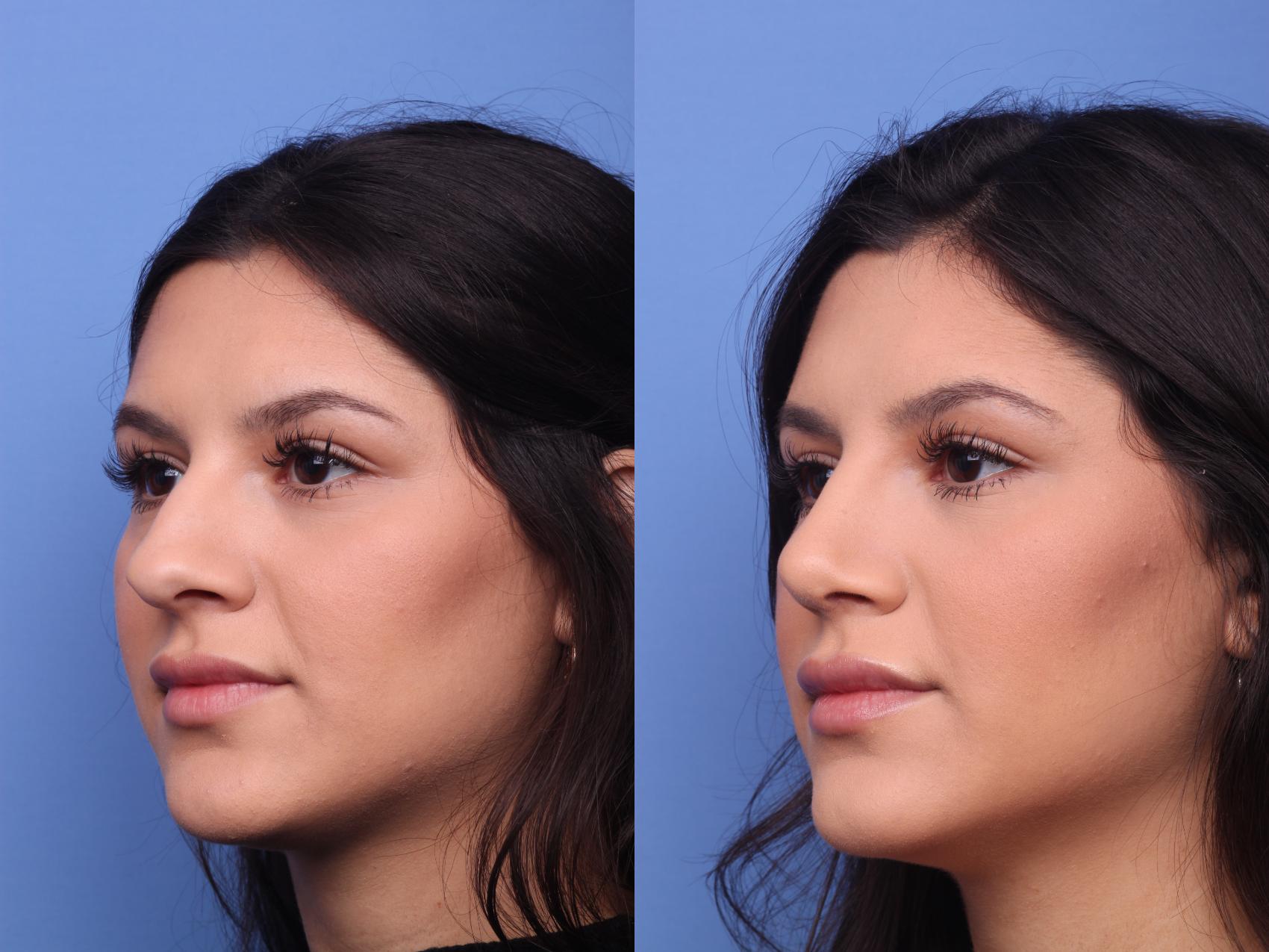 Before & After Rhinoplasty Case 143 View #3 View in Scottsdale, AZ