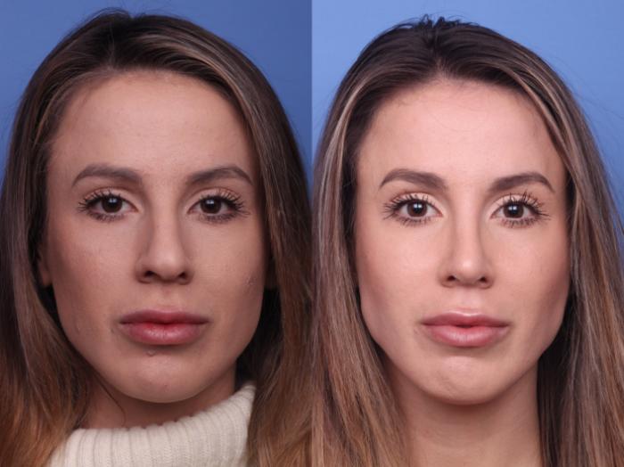 Rhinoplasty Before & After Photo | Scottsdale, AZ | Hobgood Facial Plastic Surgery: Todd Hobgood, MD