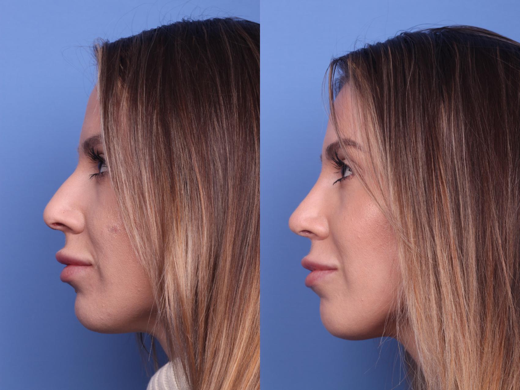Before & After Rhinoplasty Case 144 View #2 View in Scottsdale, AZ