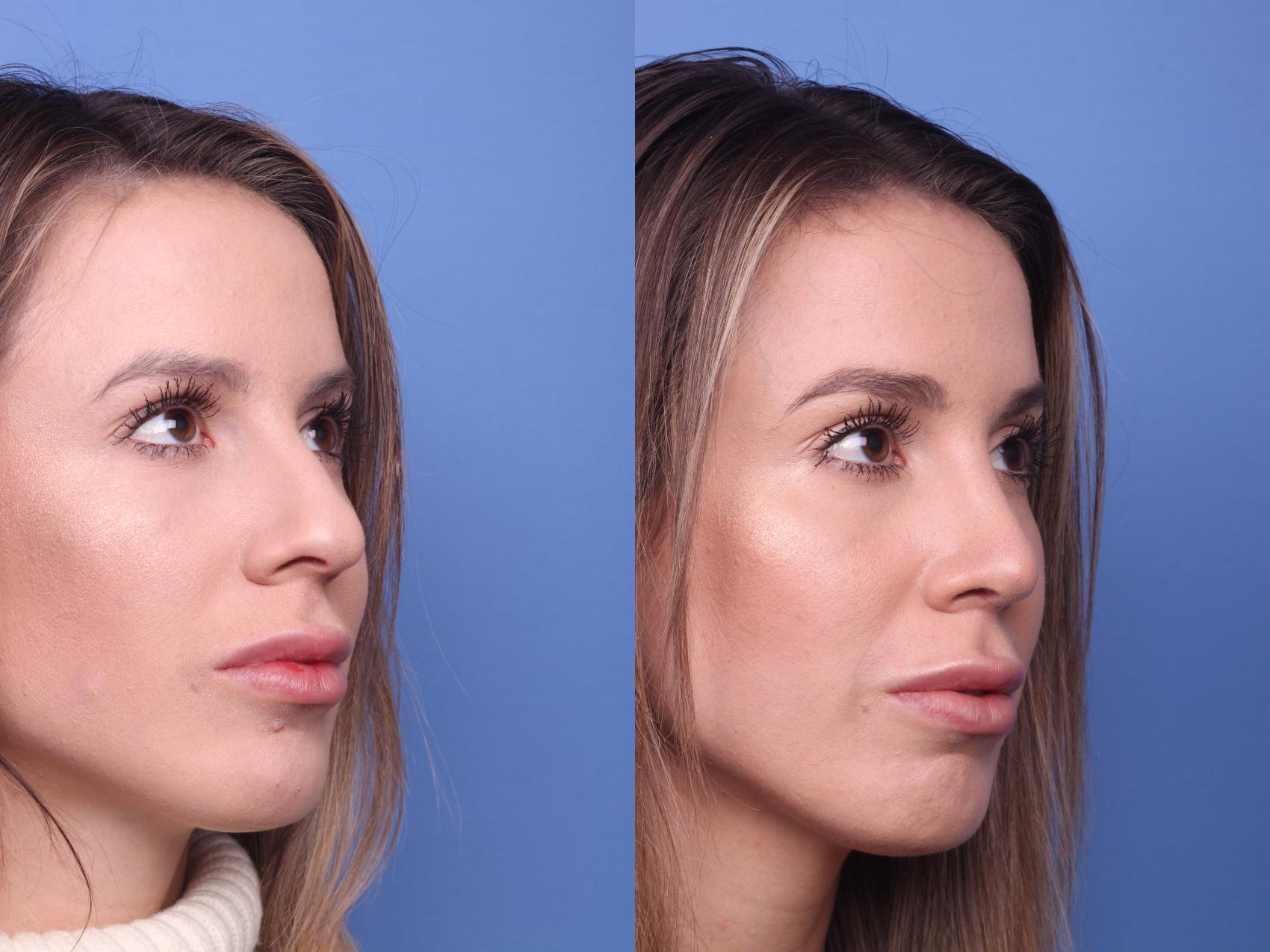 Before & After Rhinoplasty Case 144 View #3 View in Scottsdale, AZ