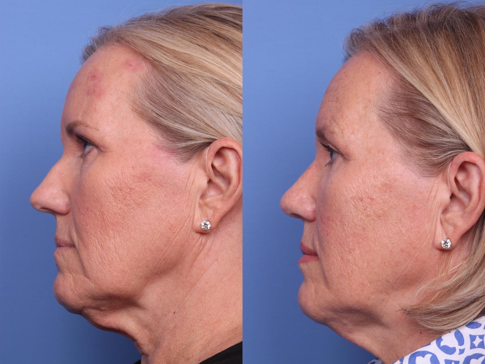 Before & After Rhinoplasty Case 146 View #2 View in Scottsdale, AZ
