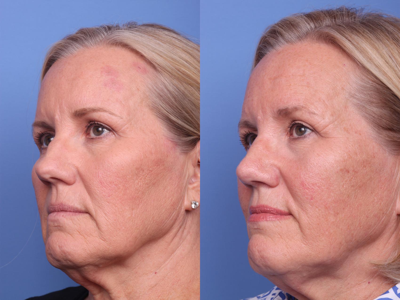 Before & After Rhinoplasty Case 146 View #3 View in Scottsdale, AZ