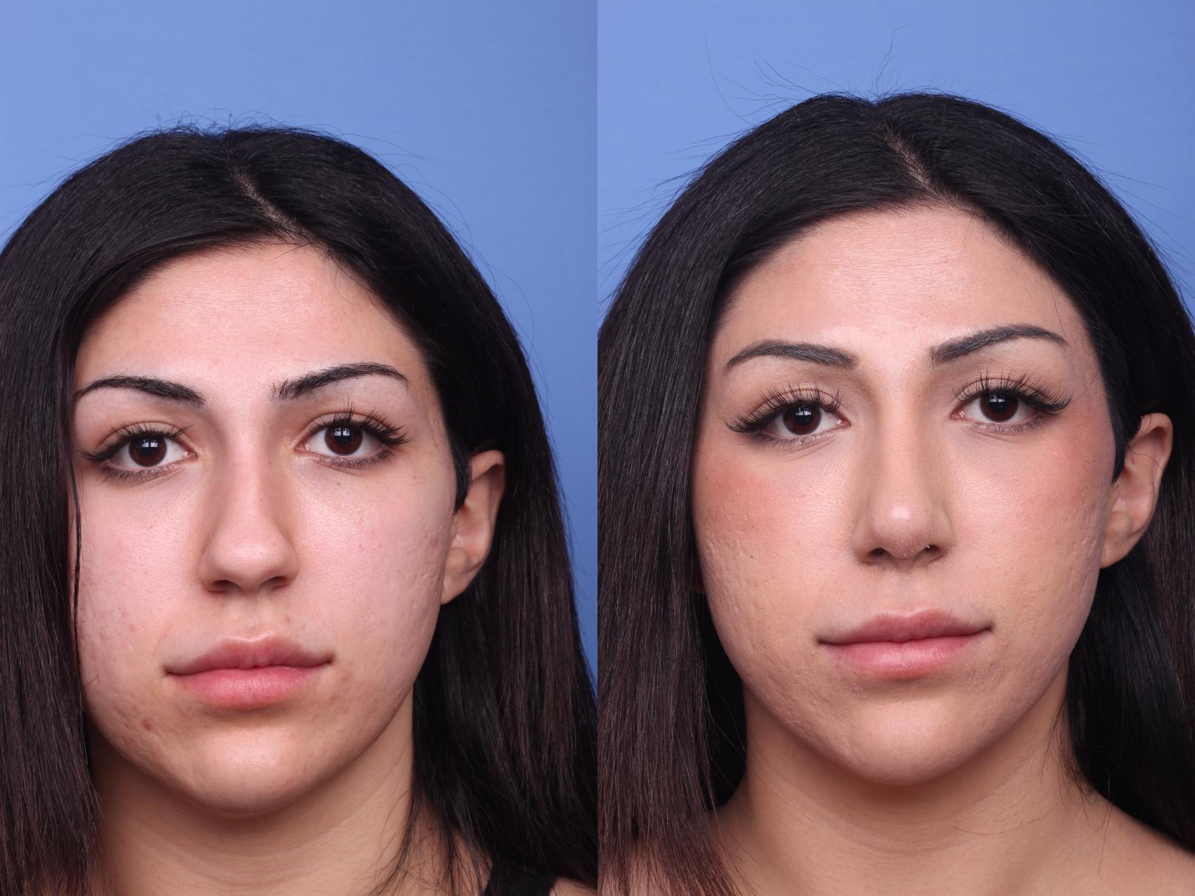 Before & After Rhinoplasty Case 147 View #2 View in Scottsdale, AZ