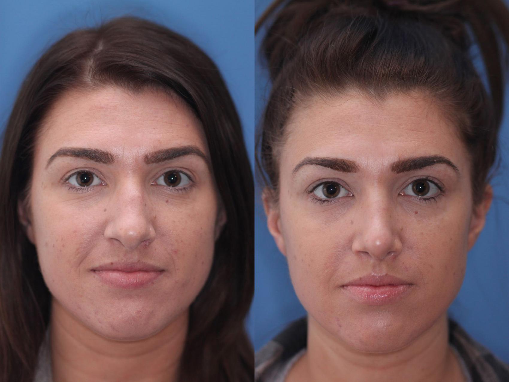 Before & After Rhinoplasty Case 15 View #2 View in Scottsdale, AZ
