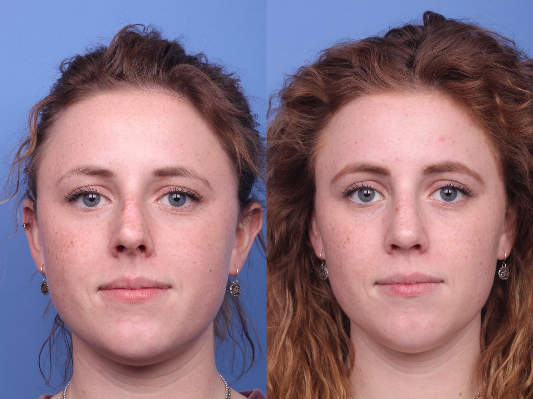 Before & After Rhinoplasty Case 151 View #2 View in Scottsdale, AZ