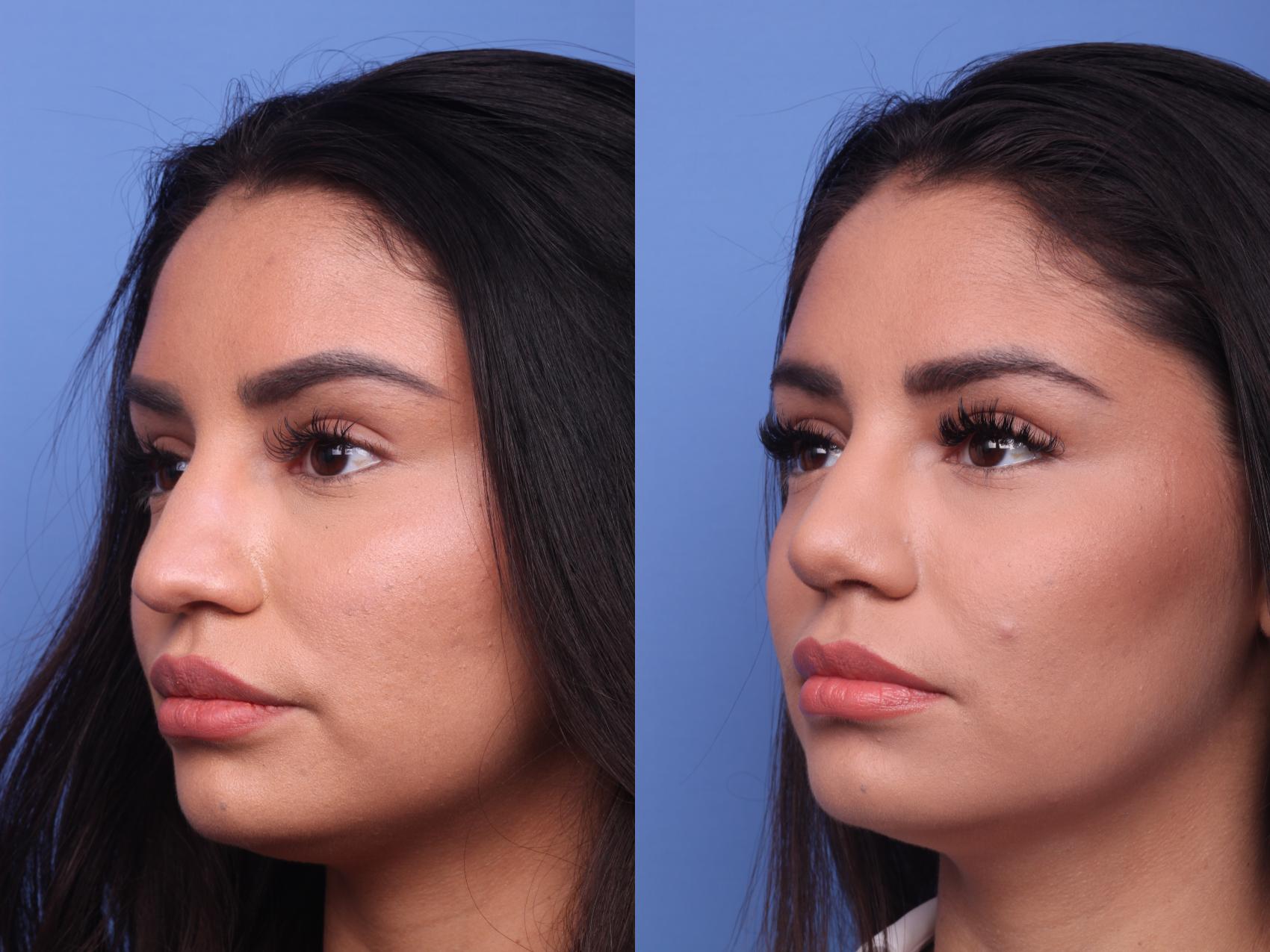 Before & After Rhinoplasty Case 152 View #2 View in Scottsdale, AZ