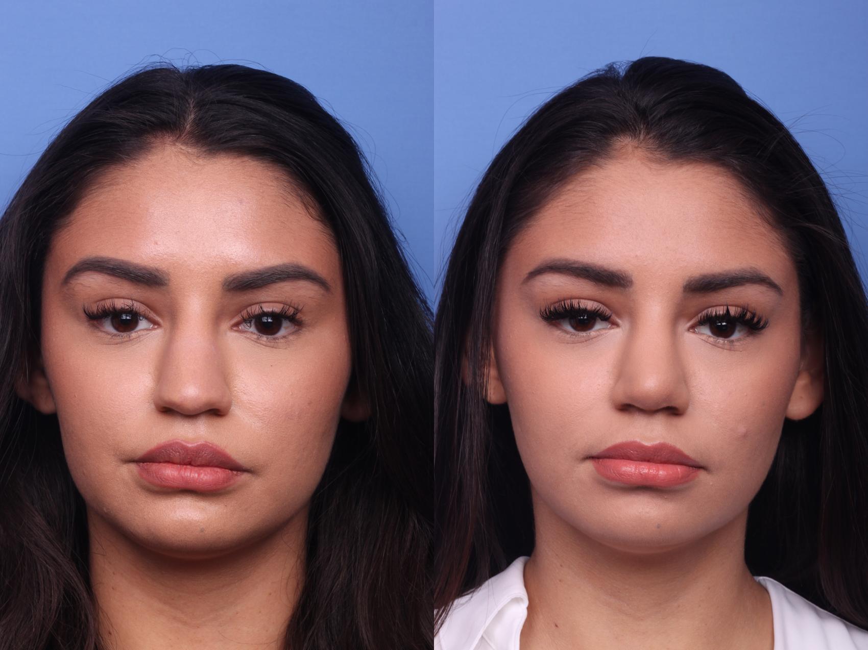 Before & After Rhinoplasty Case 152 View #3 View in Scottsdale, AZ