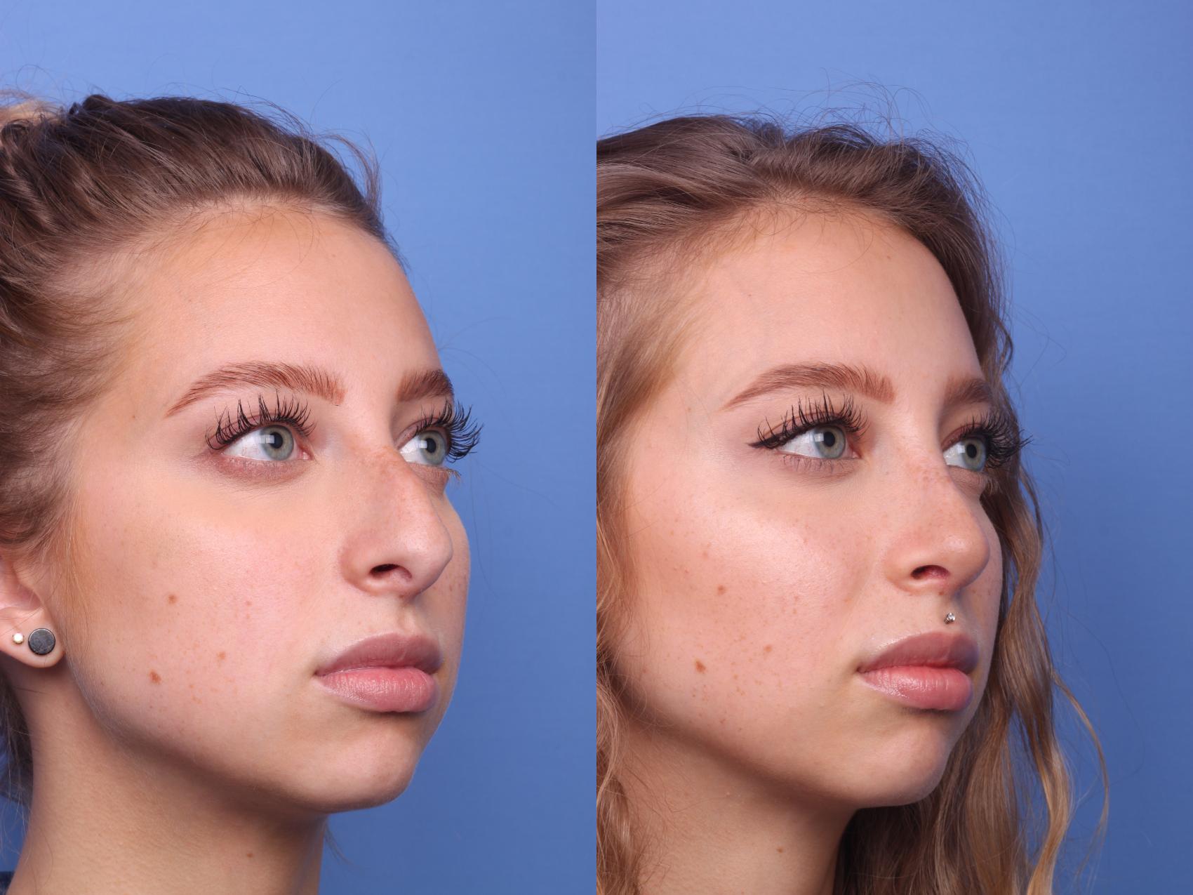 Before & After Rhinoplasty Case 153 View #2 View in Scottsdale, AZ