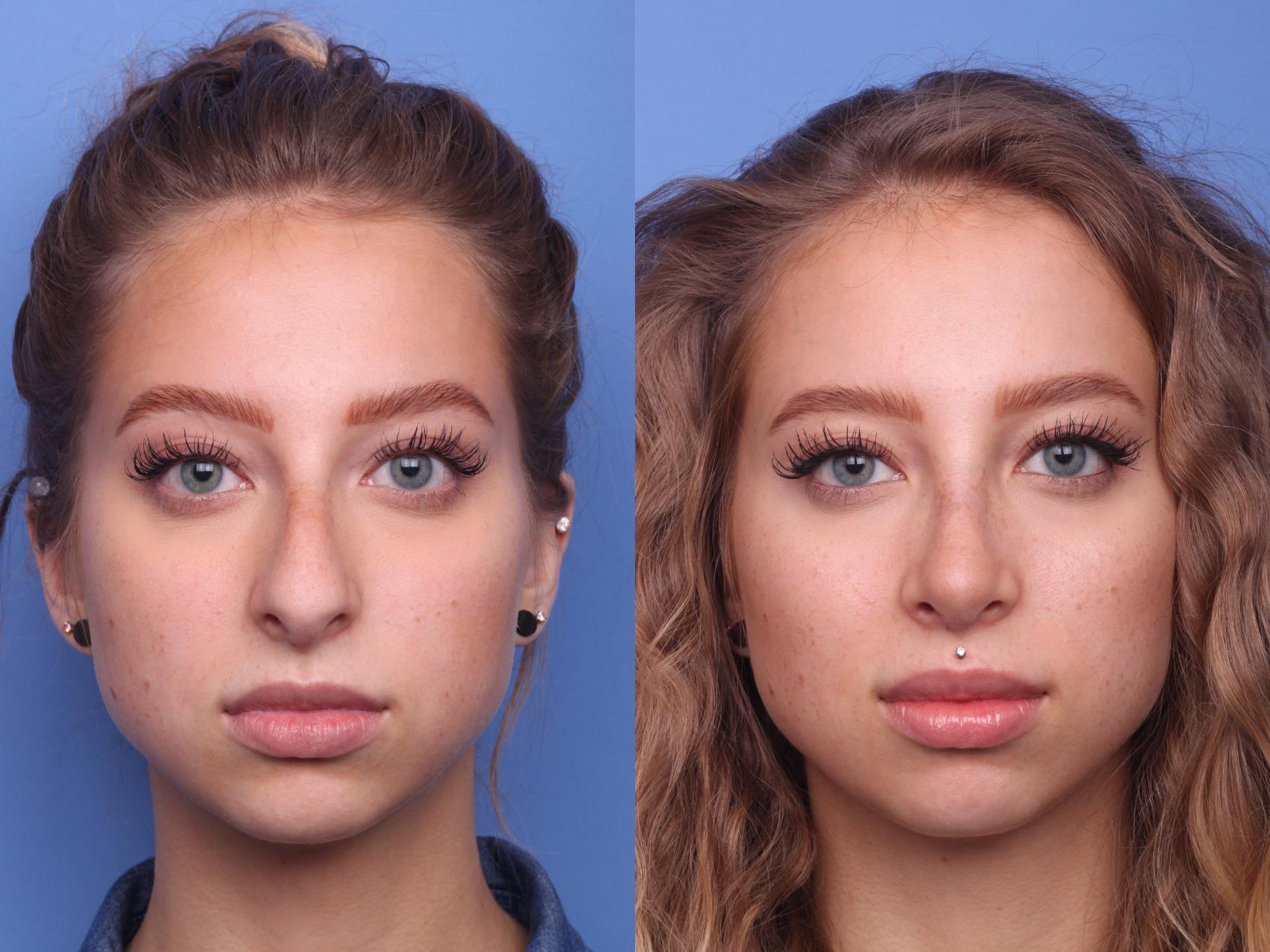Before & After Rhinoplasty Case 153 View #3 View in Scottsdale, AZ