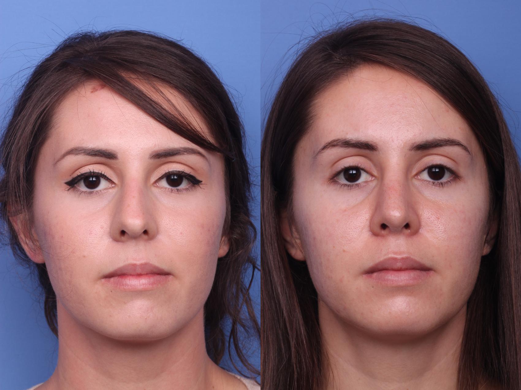 Before & After Rhinoplasty Case 154 View #2 View in Scottsdale, AZ