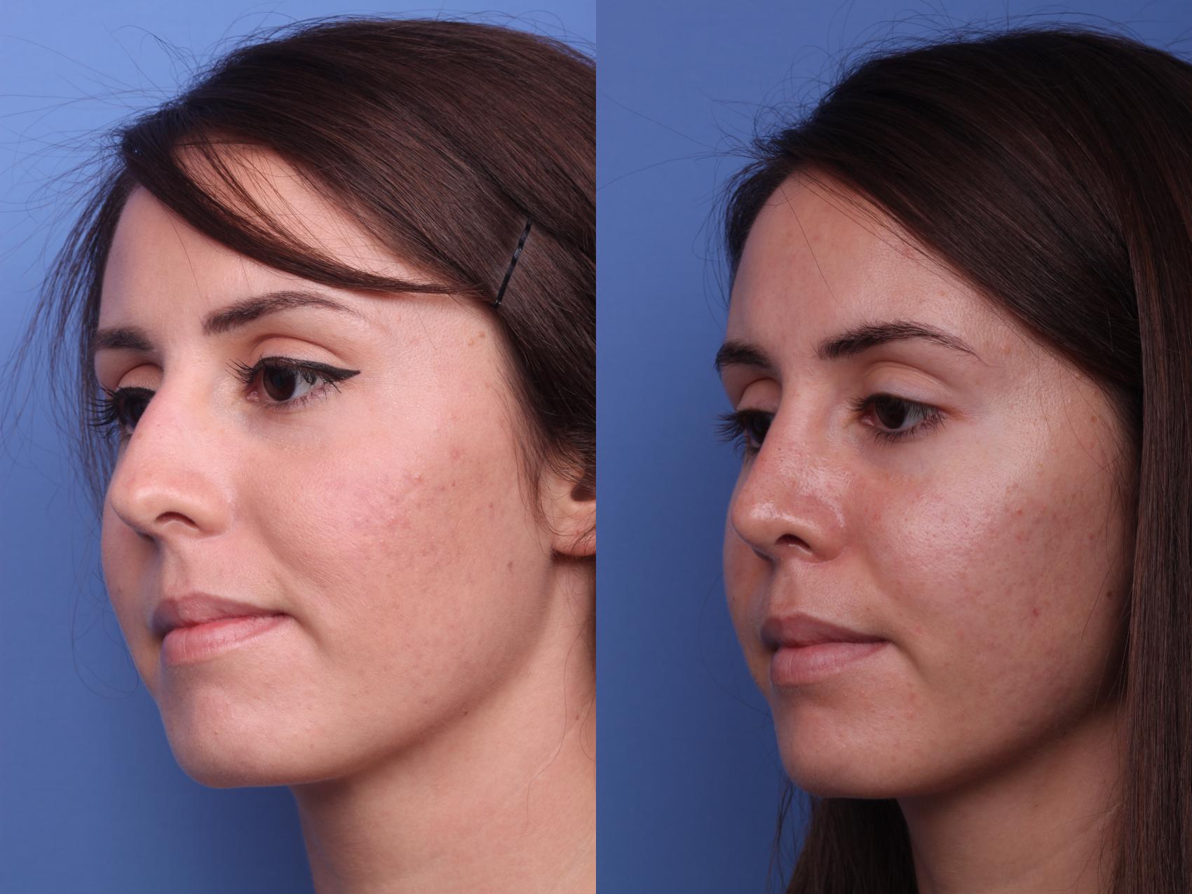 Before & After Rhinoplasty Case 154 View #3 View in Scottsdale, AZ