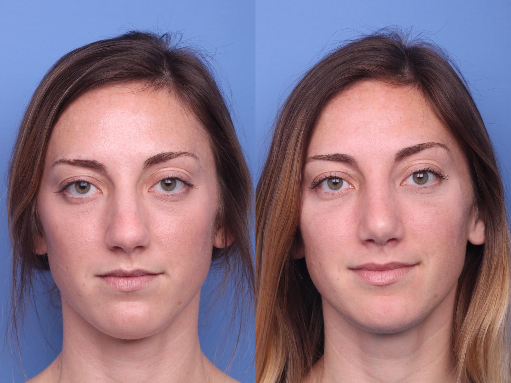 Before & After Rhinoplasty Case 156 View #2 View in Scottsdale, AZ