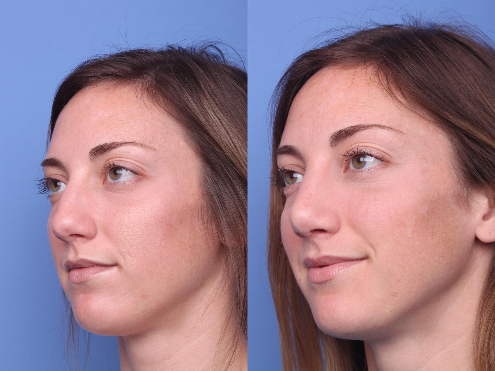 Before & After Rhinoplasty Case 156 View #3 View in Scottsdale, AZ