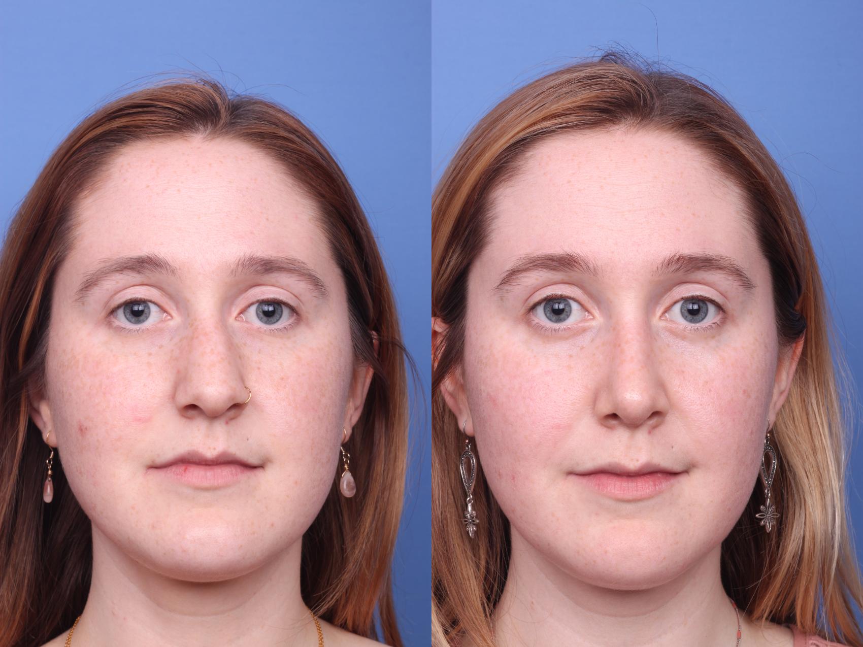Before & After Rhinoplasty Case 157 View #2 View in Scottsdale, AZ