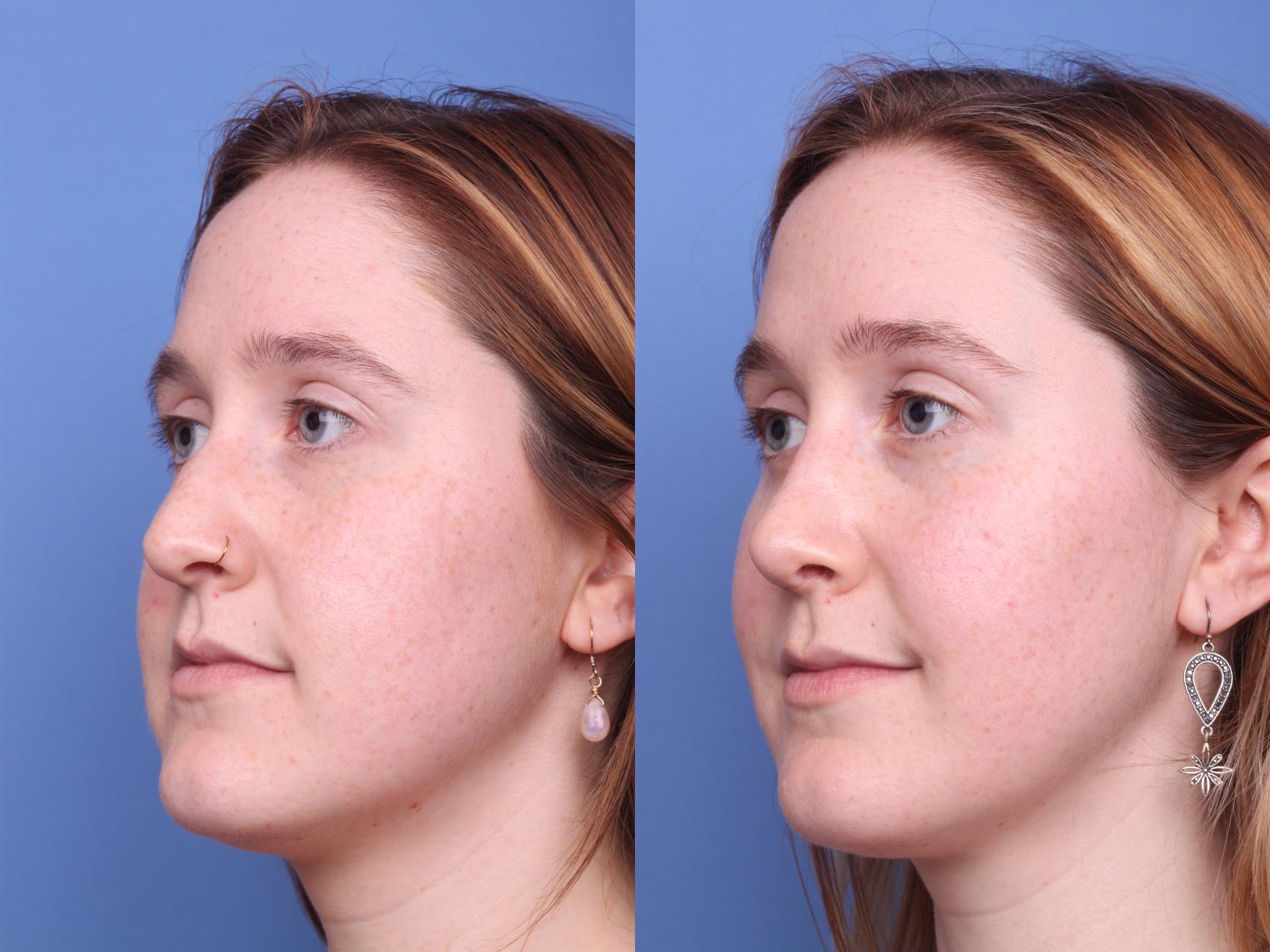 Before & After Rhinoplasty Case 157 View #3 View in Scottsdale, AZ