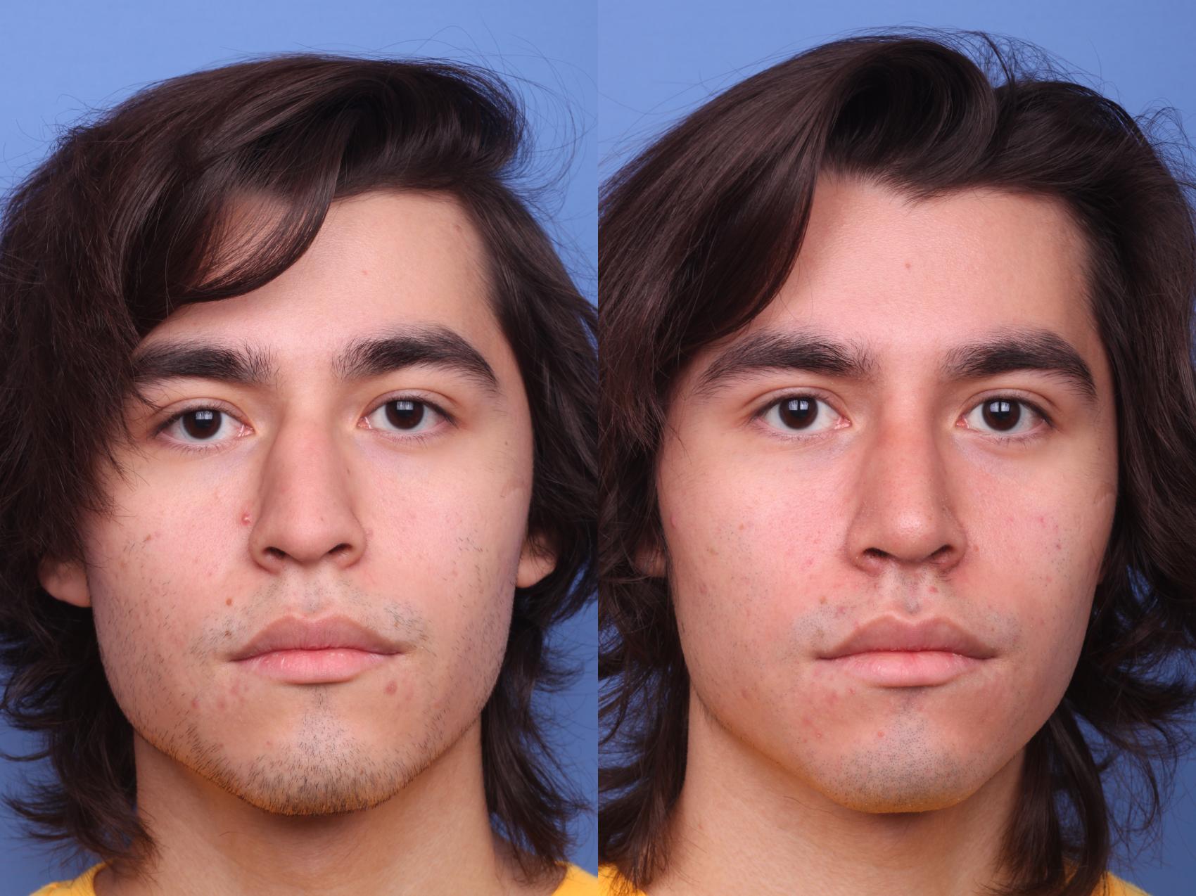 Before & After Rhinoplasty Case 158 View #1 View in Scottsdale, AZ