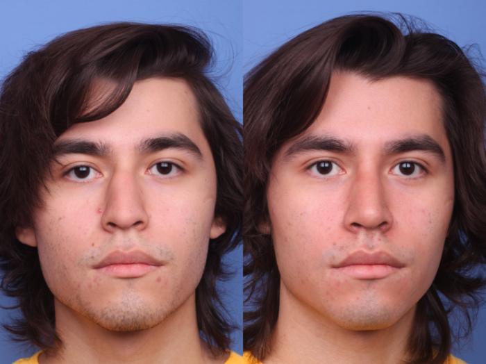 Rhinoplasty Before & After Photo | Scottsdale & Phoenix, AZ | Hobgood Facial Plastic Surgery: Todd Hobgood, MD