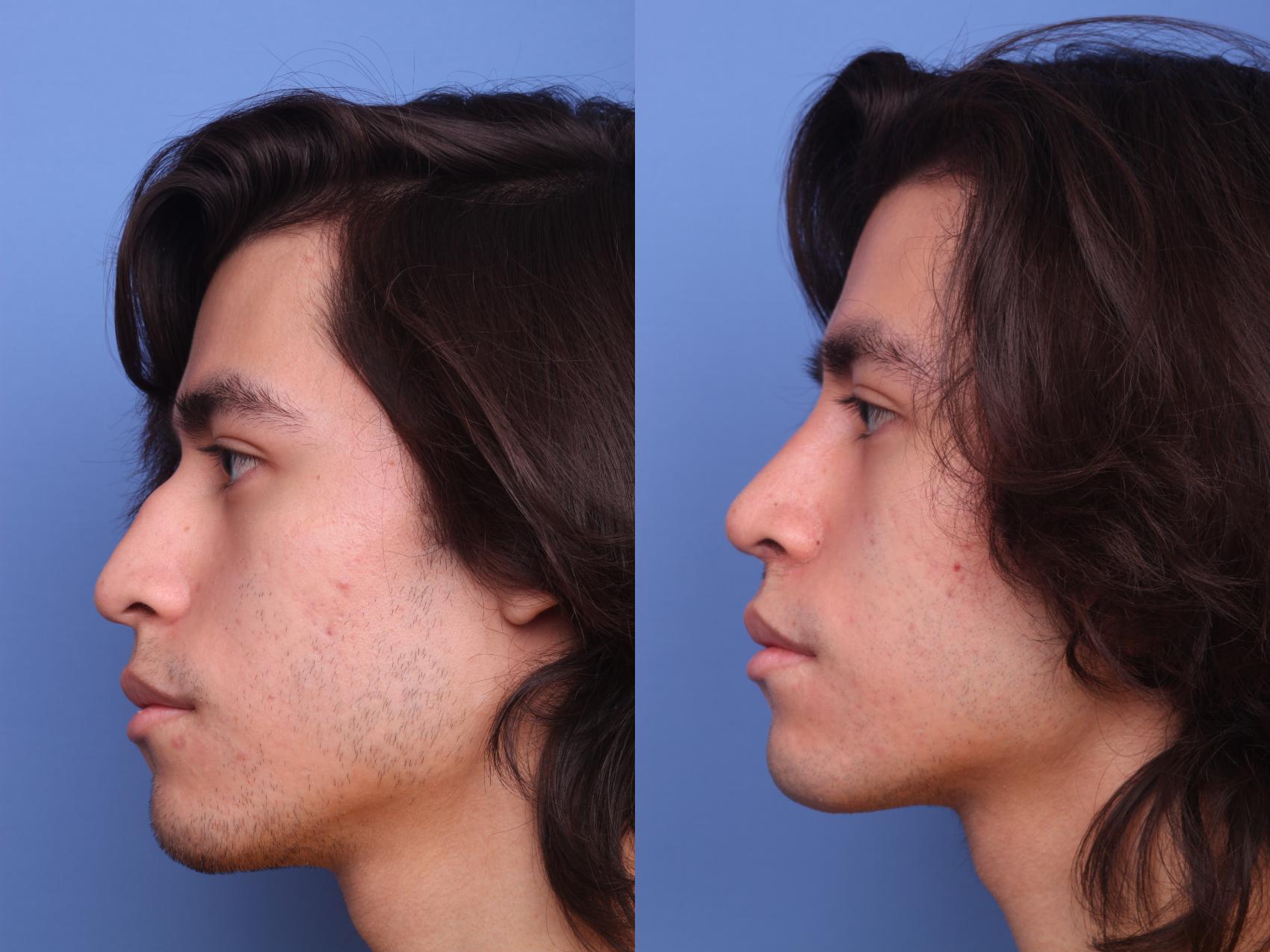 Rhinoplasty Before & After Photo | Scottsdale & Phoenix, AZ | Hobgood Facial Plastic Surgery: Todd Hobgood, MD