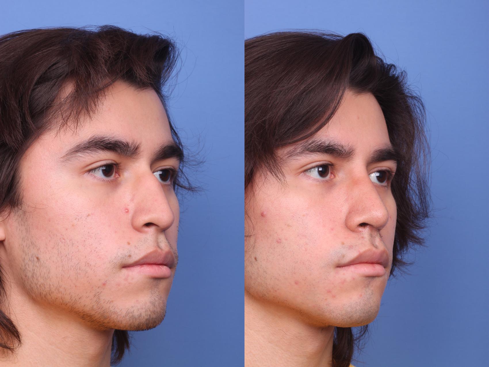 Before & After Rhinoplasty Case 158 View #3 View in Scottsdale, AZ