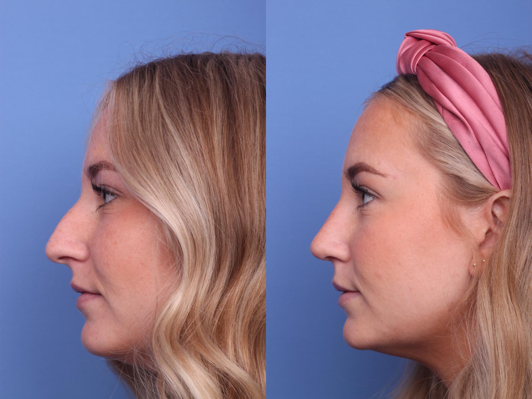Before & After Rhinoplasty Case 159 View #2 View in Scottsdale, AZ