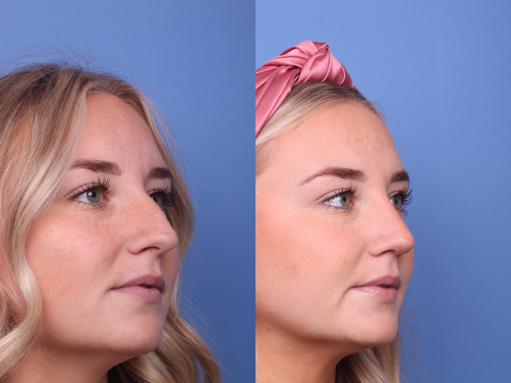 Before & After Rhinoplasty Case 159 View #3 View in Scottsdale, AZ