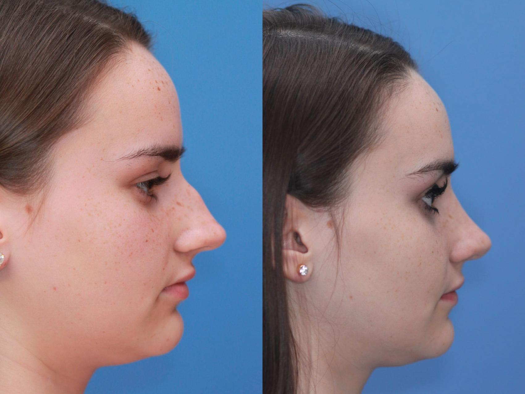 Before & After Rhinoplasty Case 16 View #2 View in Scottsdale, AZ