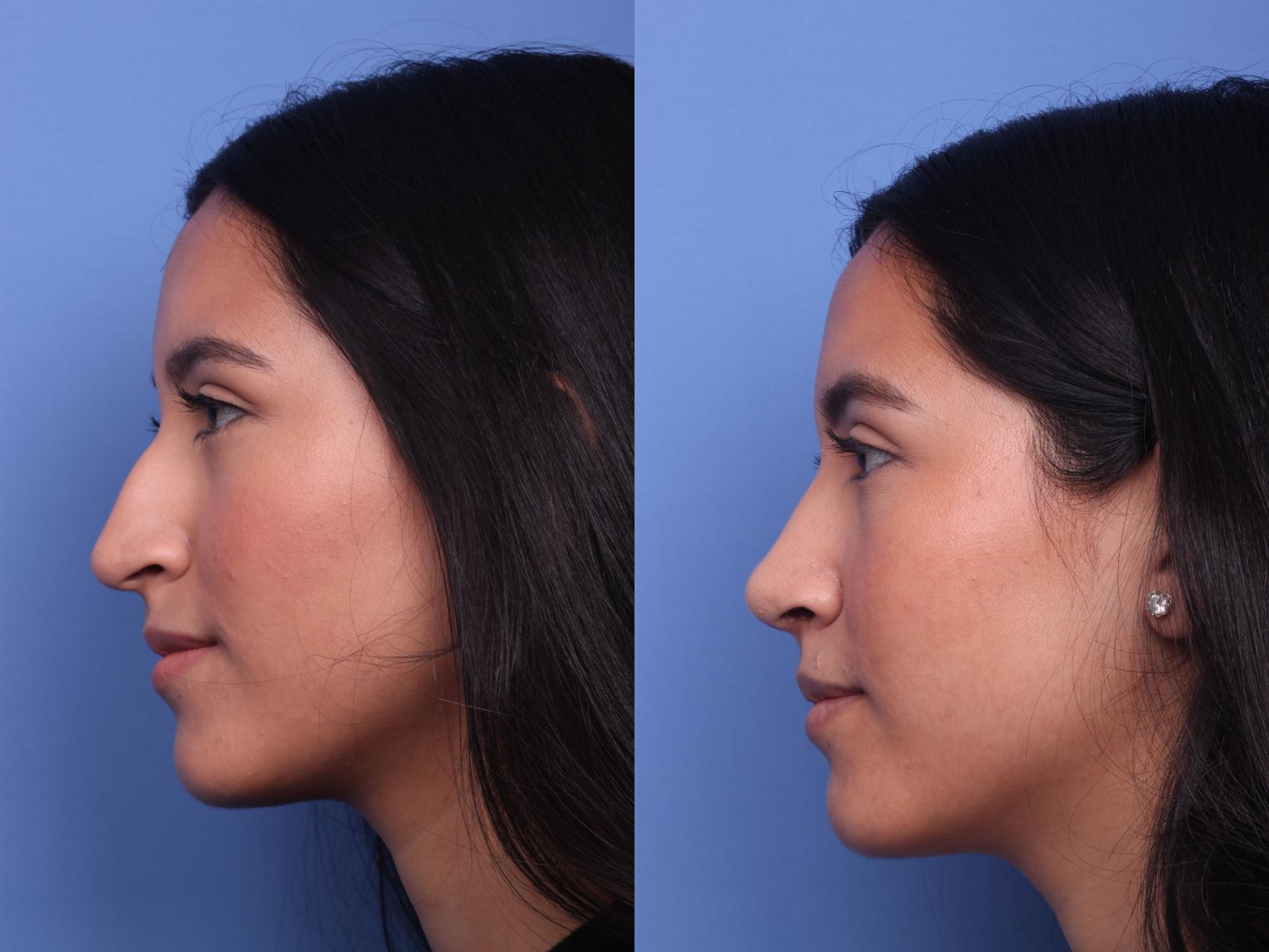 Before & After Rhinoplasty Case 160 View #2 View in Scottsdale, AZ