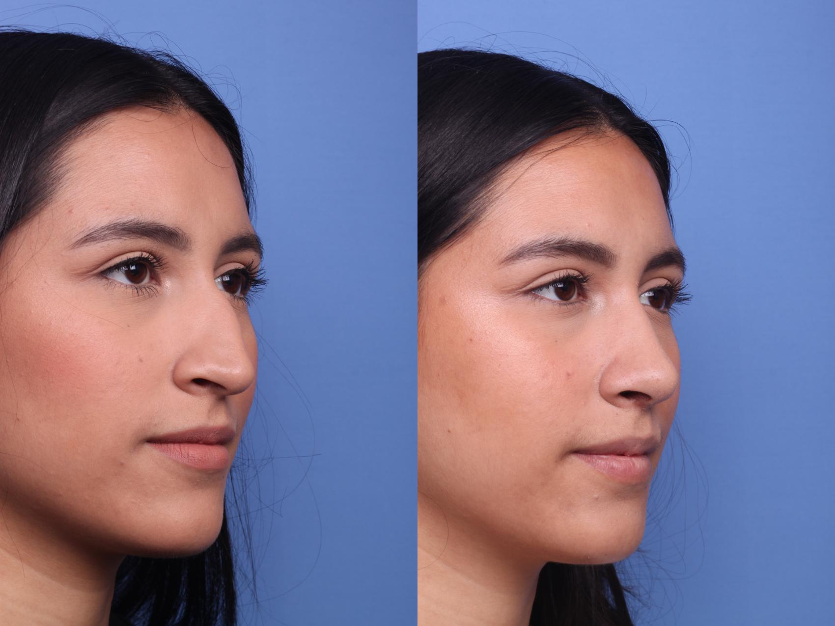 Before & After Rhinoplasty Case 160 View #3 View in Scottsdale, AZ