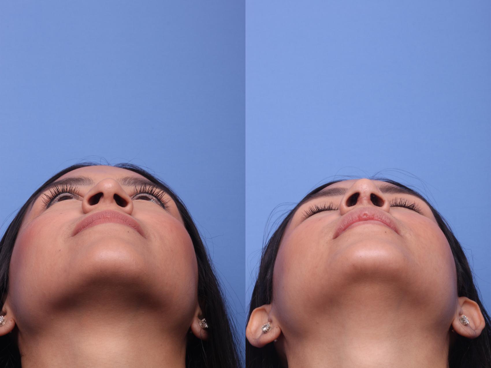 Before & After Rhinoplasty Case 160 View #4 View in Scottsdale, AZ