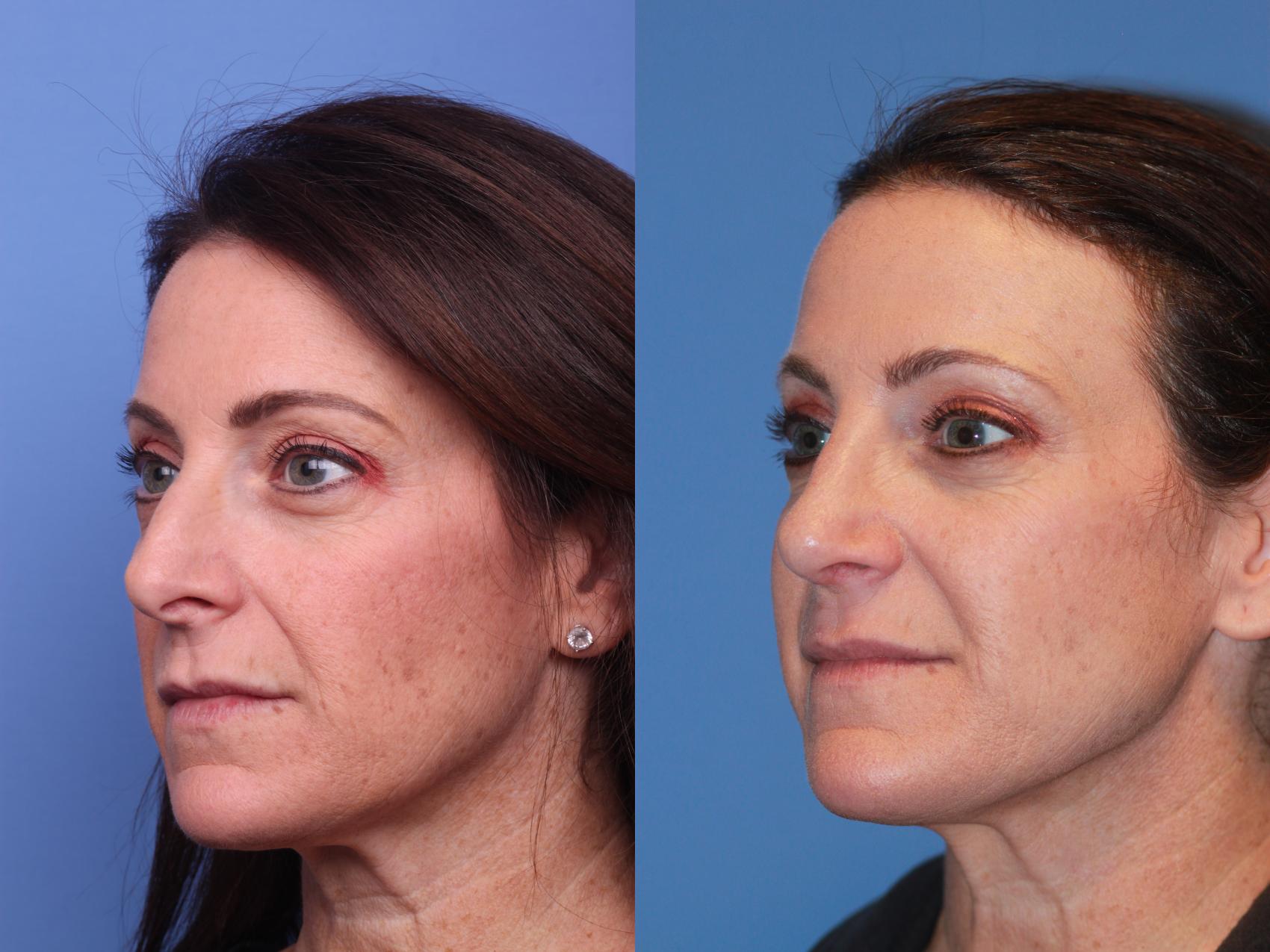 Before & After Rhinoplasty Case 164 View #2 View in Scottsdale, AZ