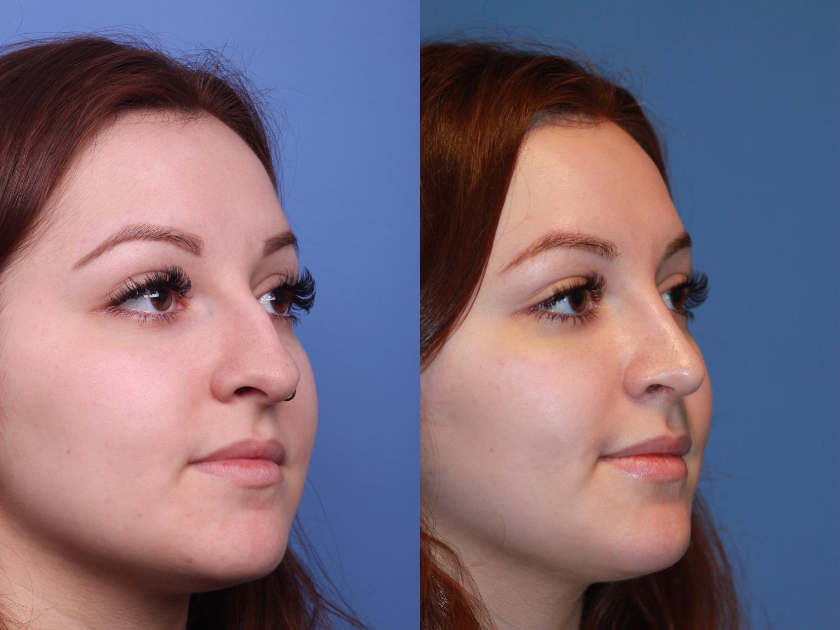 Before & After Rhinoplasty Case 165 View #2 View in Scottsdale, AZ