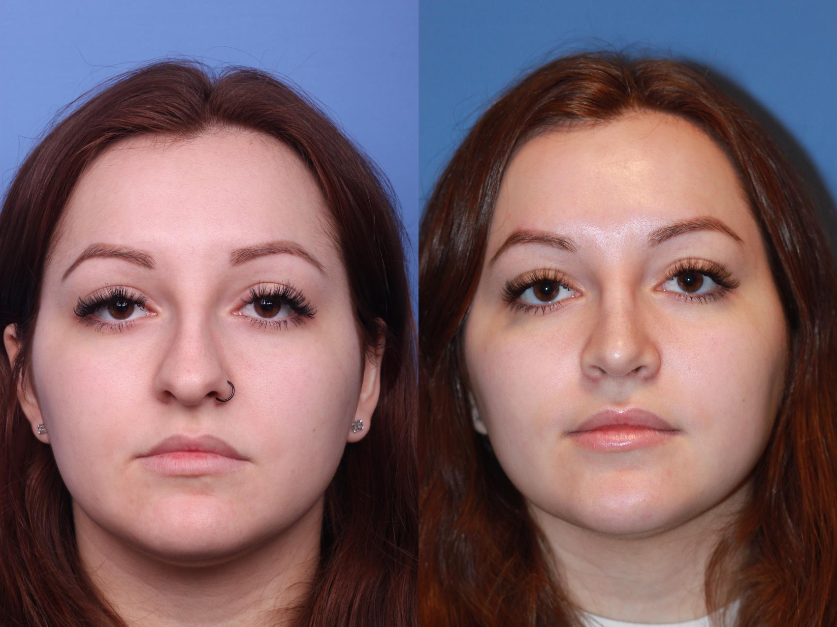 Before & After Rhinoplasty Case 165 View #3 View in Scottsdale, AZ