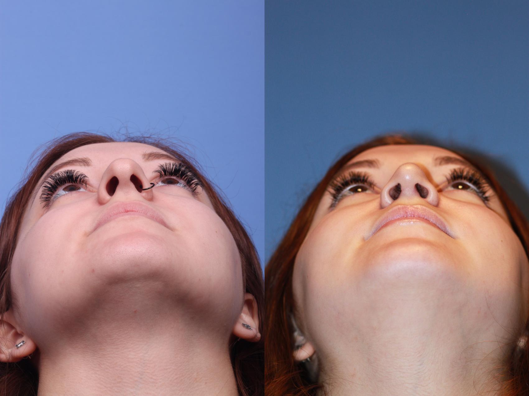 Before & After Rhinoplasty Case 165 View #4 View in Scottsdale, AZ