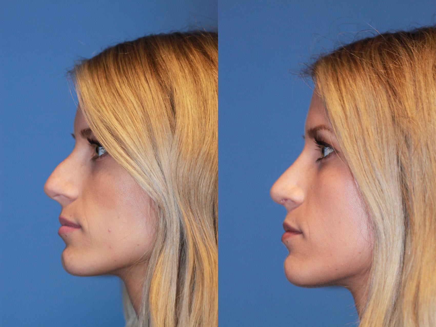 Before & After Rhinoplasty Case 166 View #2 View in Scottsdale, AZ