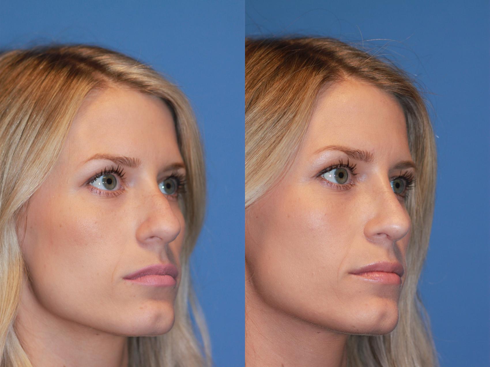 Before & After Rhinoplasty Case 166 View #3 View in Scottsdale, AZ