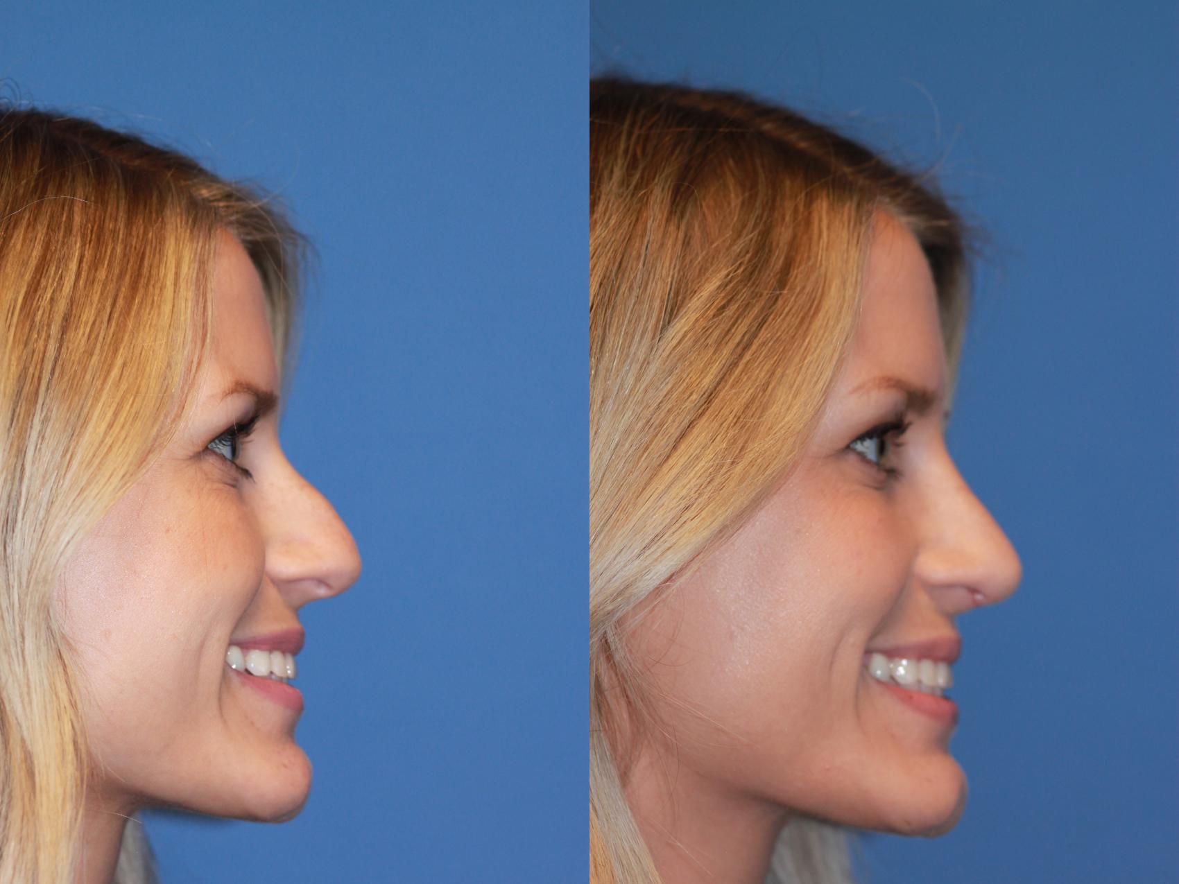 Before & After Rhinoplasty Case 166 View #4 View in Scottsdale, AZ