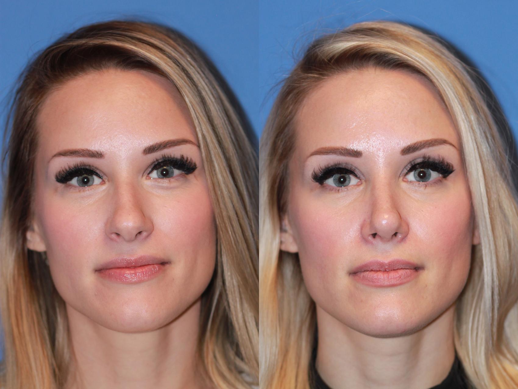 Before & After Rhinoplasty Case 167 View #1 View in Scottsdale, AZ