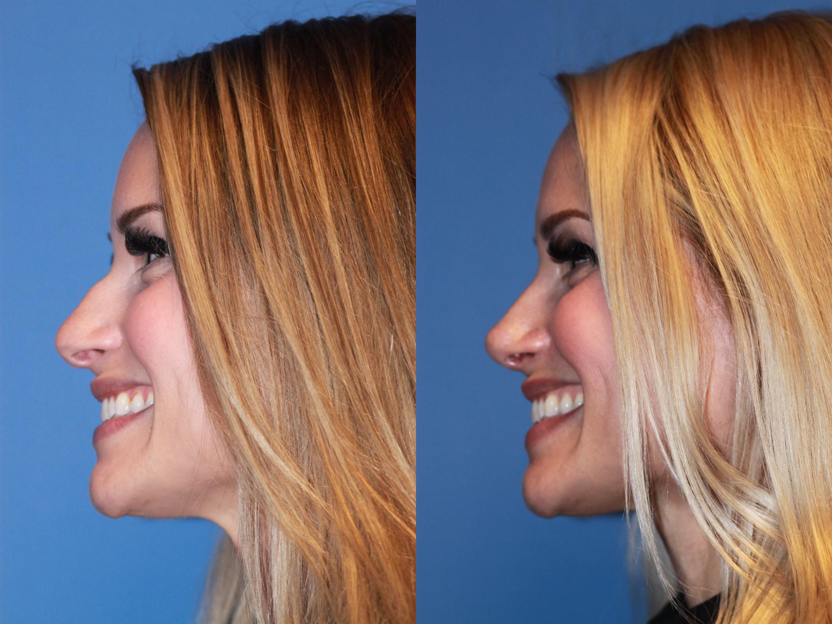 Before & After Rhinoplasty Case 167 View #2 View in Scottsdale, AZ
