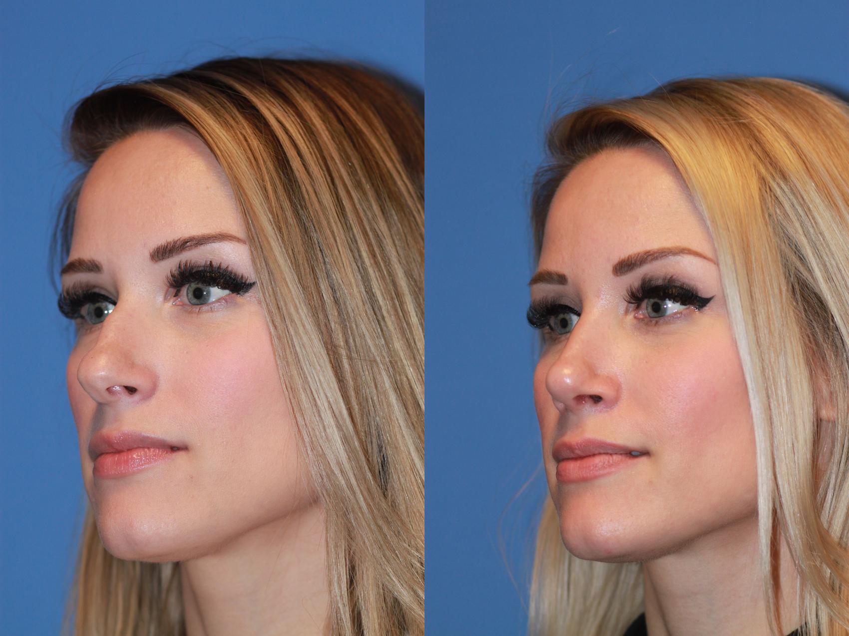 Before & After Rhinoplasty Case 167 View #4 View in Scottsdale, AZ
