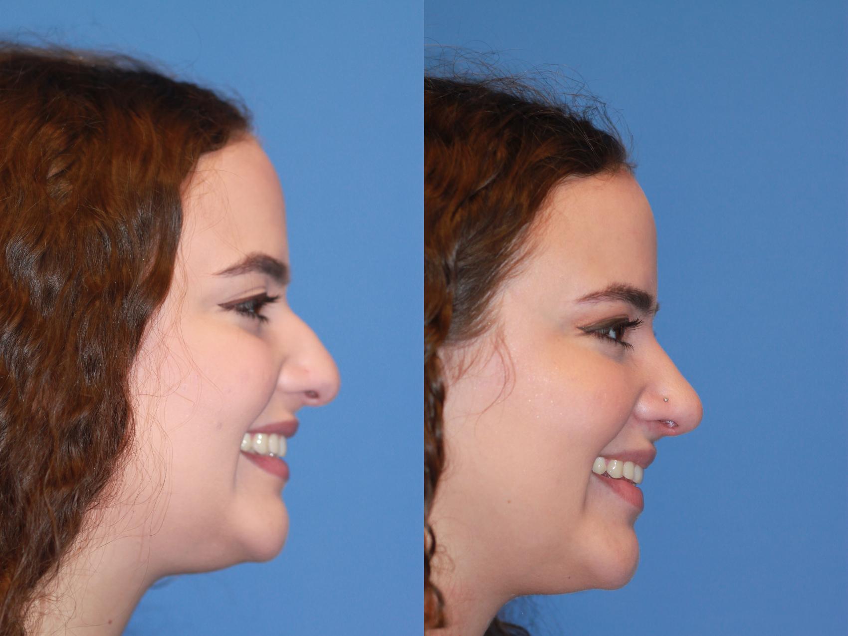 Before & After Rhinoplasty Case 168 View #2 View in Scottsdale, AZ