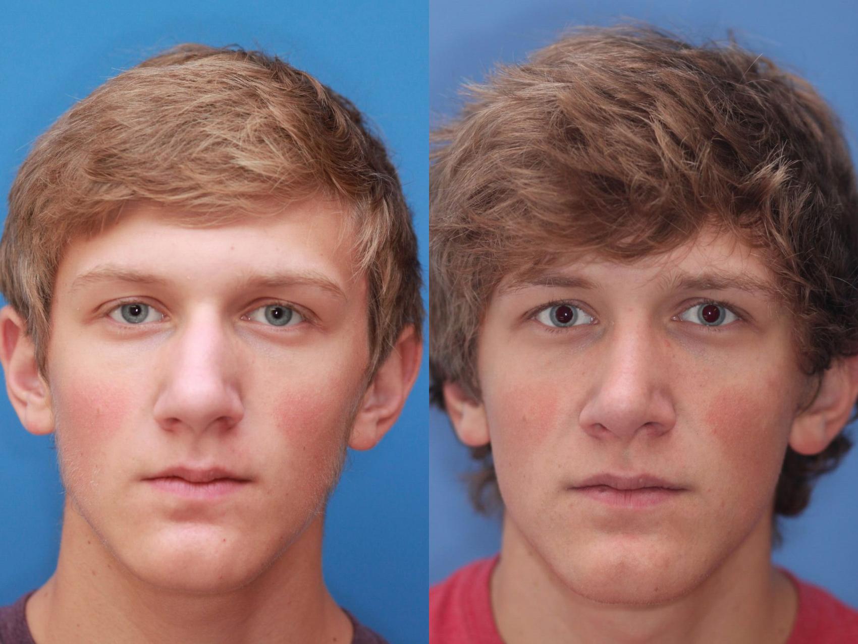 Before & After Rhinoplasty Case 17 View #1 View in Scottsdale, AZ