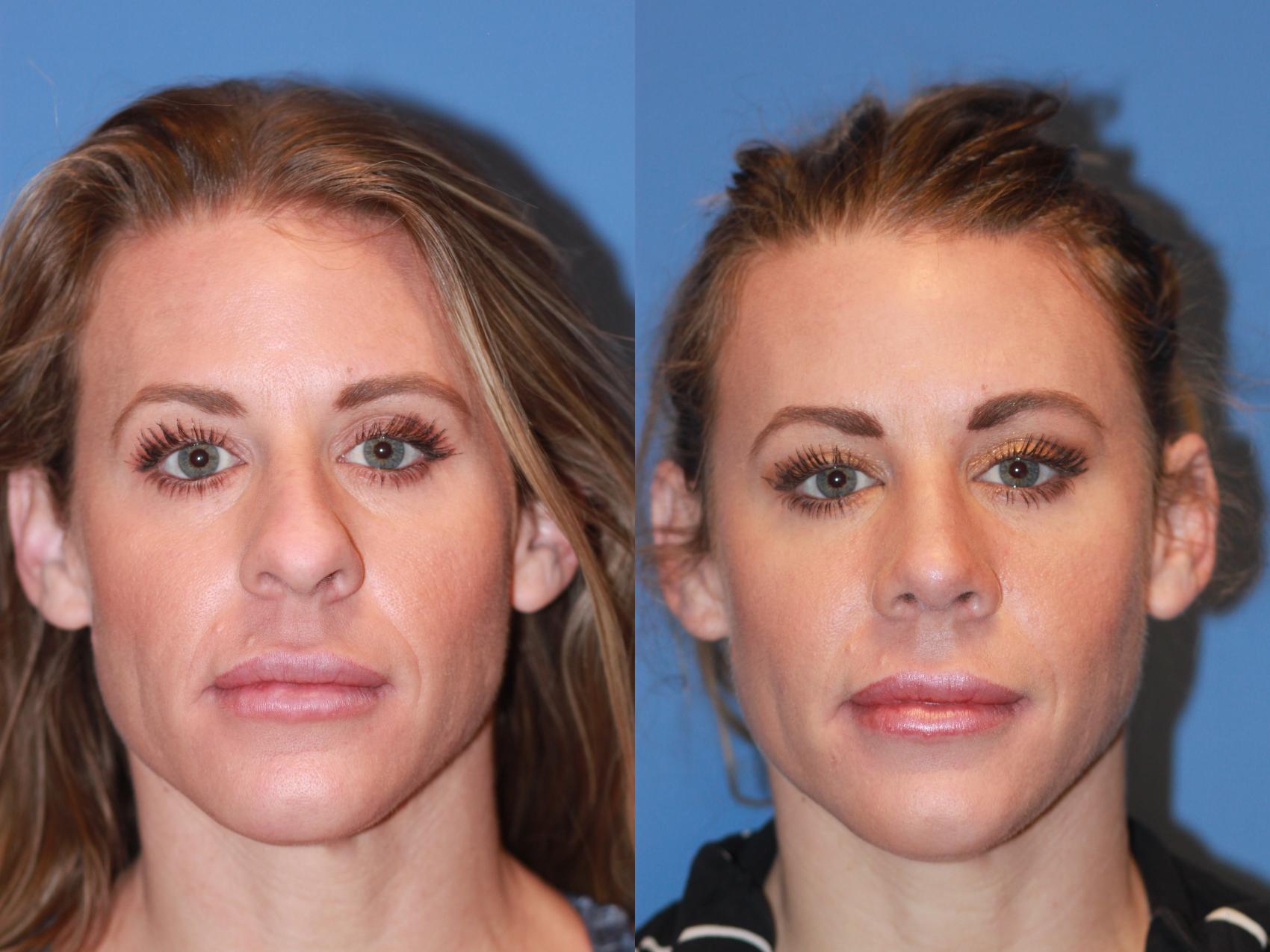 Before & After Rhinoplasty Case 170 View #2 View in Scottsdale, AZ